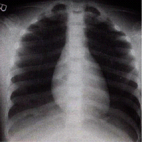 Diagrama Tórax AP Lordosis